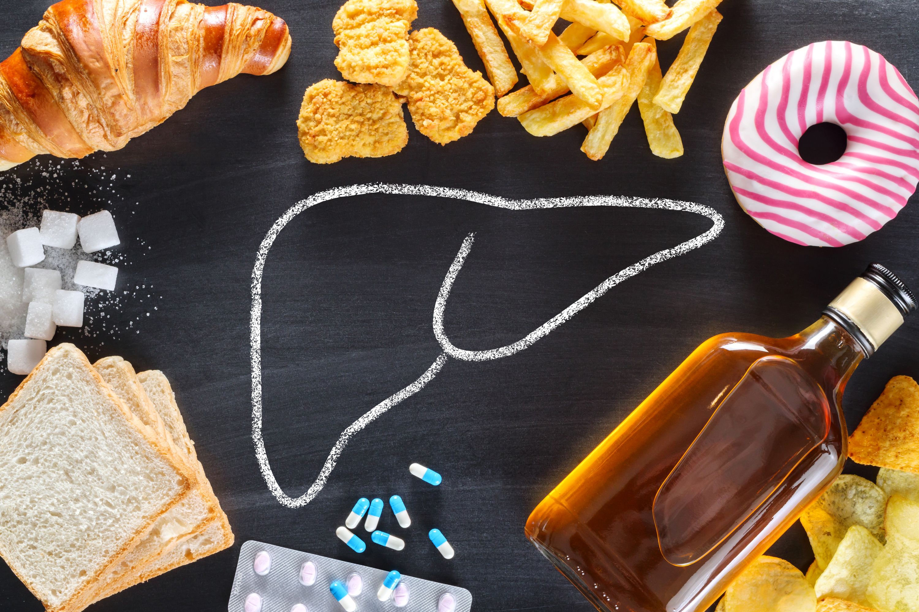 Fettleber bei Diabetes: wen abklären, wen behandeln, wen überweisen?